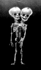 conjoined twins skeleton